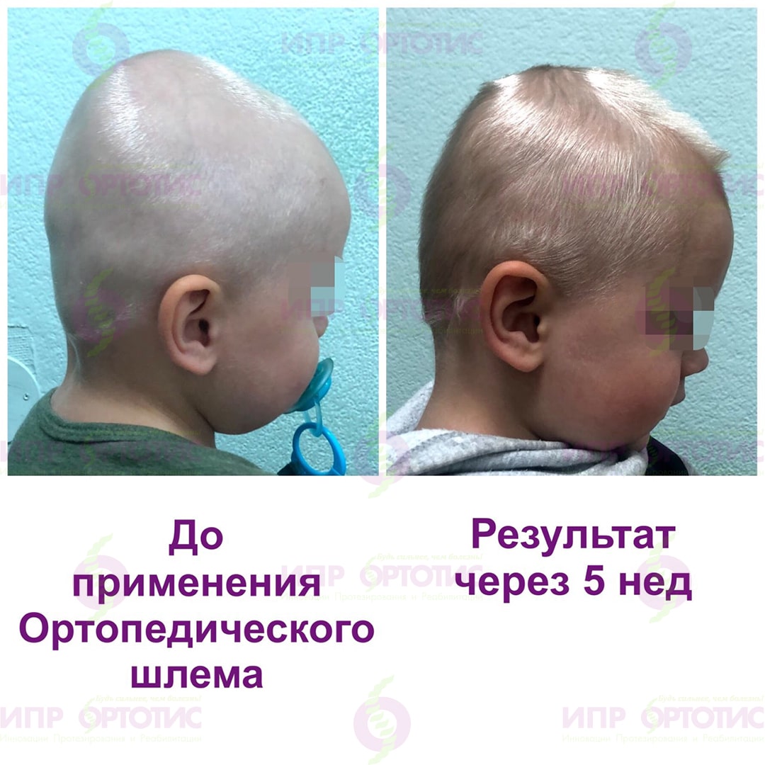 Форма головы у новорожденных
